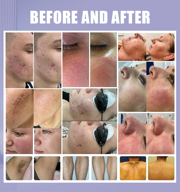 IPL OPT Machine, Aesthetic Laser Hair Remover, E-Light Skin Rejuvenation Machine, Vascular Multi-Application Hair Removal