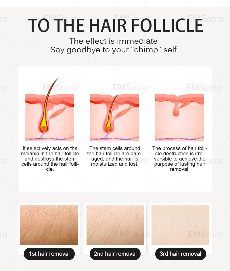 Freezing Point, Private Parts, Body, Face, 808nm Diode Laser Hair Removal Machine, Multifunction Permanent Painless Epilator